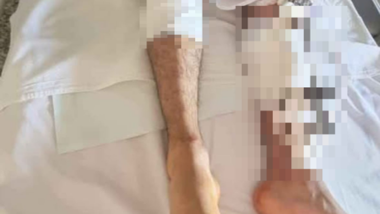 Le quebraron ambas piernas cuando iba a trabajar en su moto